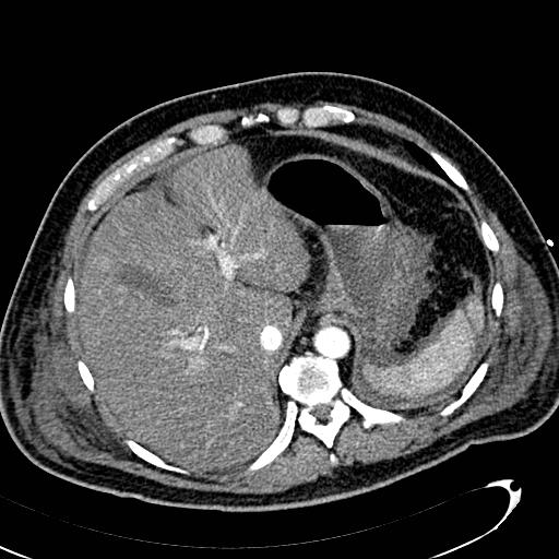 File:Acute pancreatic necrosis (Radiopaedia 13560-13486 Axial C+ portal venous phase 33).jpg