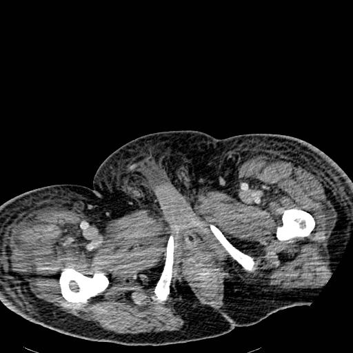 Acute pancreatic necrosis (Radiopaedia 13560-18501 Axial C+ portal venous phase 161).jpg