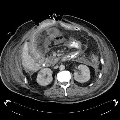 File:Acute pancreatic necrosis (Radiopaedia 13560-18503 Axial C+ portal venous phase 36).jpg