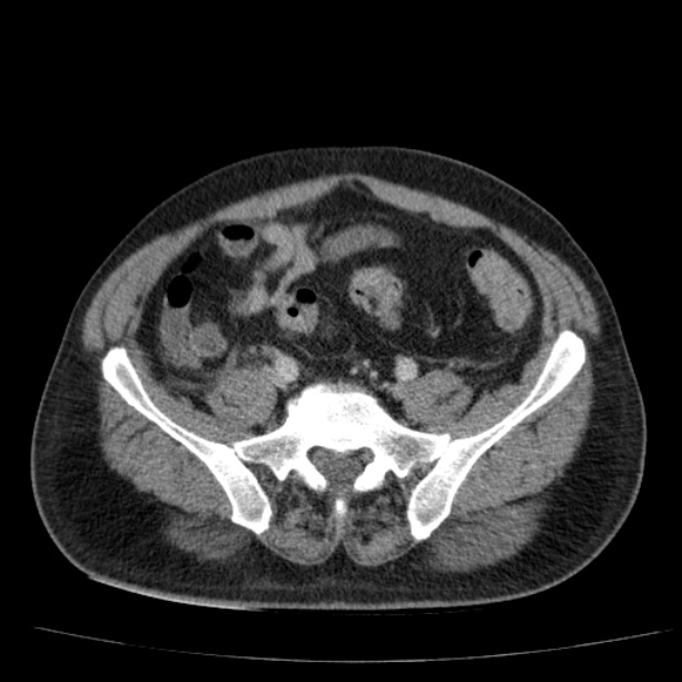 Acute pancreatitis (Radiopaedia 26663-26813 Axial C+ portal venous phase 64).jpg