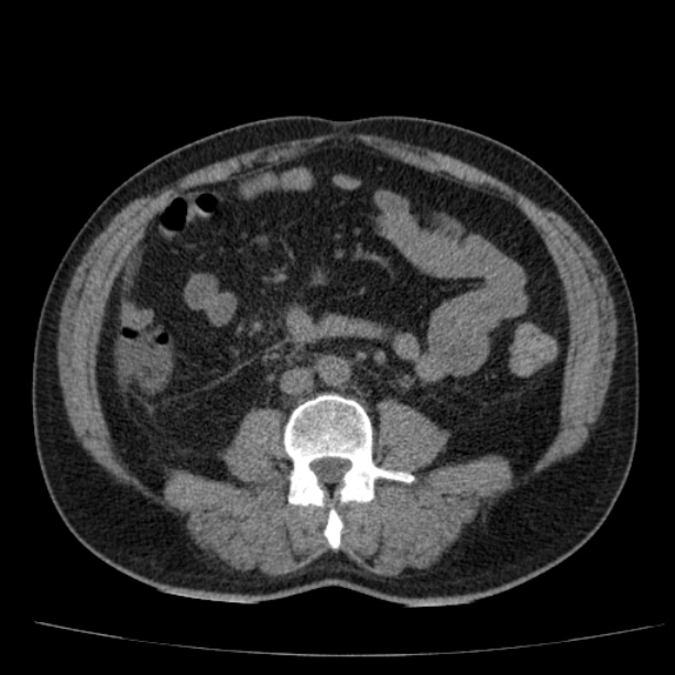 Acute pancreatitis (Radiopaedia 26663-26813 Axial non-contrast 60).jpg