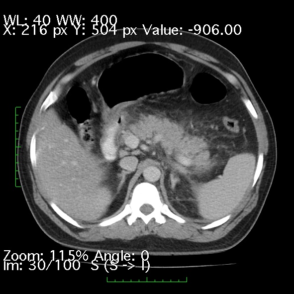 Acute pancreatitis (Radiopaedia 34043-35276 Axial C+ portal venous phase 30).jpg