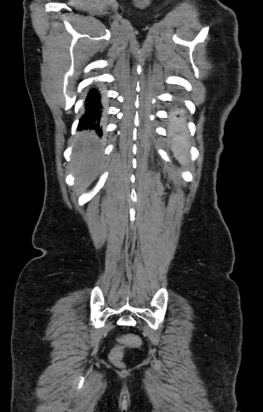 Acute pancreatitis (Radiopaedia 80007-93285 Coronal C+ portal venous phase 133).jpg