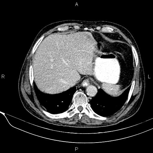 Acute pancreatitis (Radiopaedia 85146-100701 Axial C+ portal venous phase 15).jpg