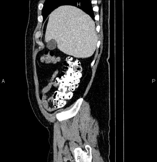 Acute pancreatitis (Radiopaedia 85390-101010 Sagittal C+ portal venous phase 12).jpg