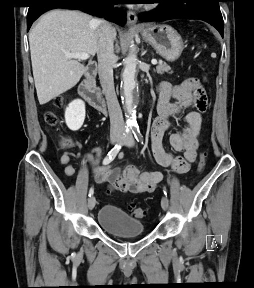 Acute renal infarction (Radiopaedia 59375-66736 Coronal C+ portal venous phase 31).jpg