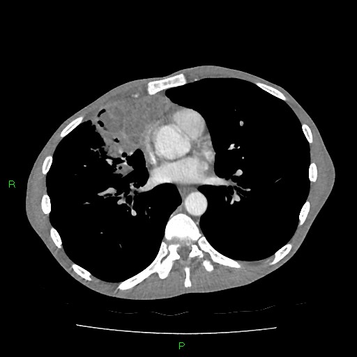 File:Acute right lung abscess (Radiopaedia 34806-36258 Axial C+ arterial phase 109).jpg