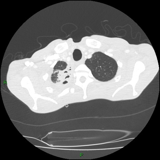 File:Acute right lung abscess (Radiopaedia 34806-36258 Axial lung window 18).jpg