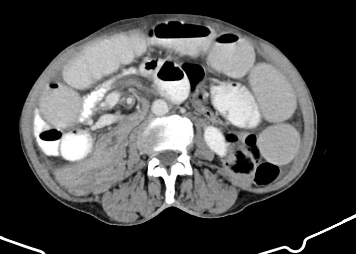 Acute small bowel (ileal) volvulus (Radiopaedia 71740-82139 Axial C+ portal venous phase 106).jpg