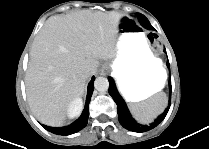 Acute small bowel (ileal) volvulus (Radiopaedia 71740-82139 Axial C+ portal venous phase 52).jpg