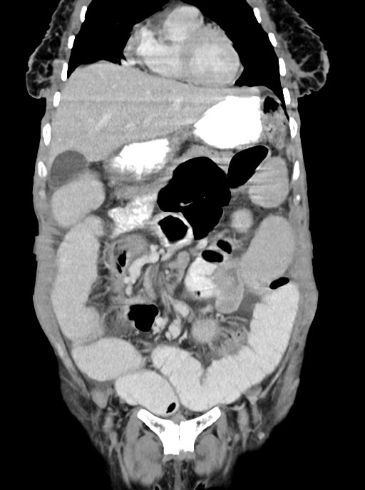 Acute small bowel (ileal) volvulus (Radiopaedia 71740-82139 Coronal C+ portal venous phase 37).jpg