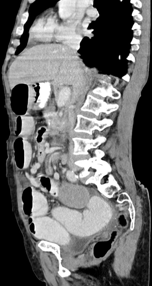 Acute small bowel (ileal) volvulus (Radiopaedia 71740-82139 Sagittal C+ portal venous phase 96).jpg