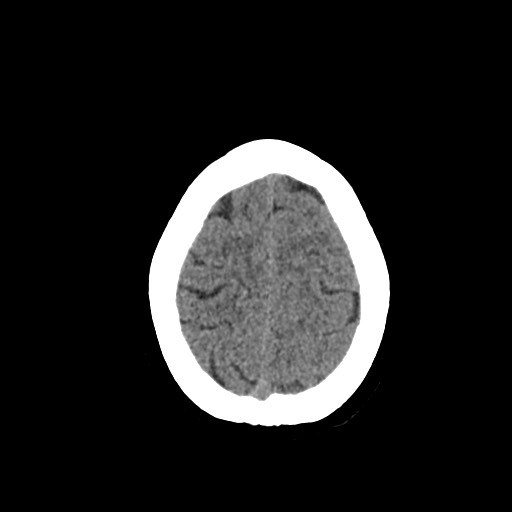 Acute subarachnoid hemorrhage and accessory anterior cerebral artery (Radiopaedia 69231-79008 Axial non-contrast 46).jpg