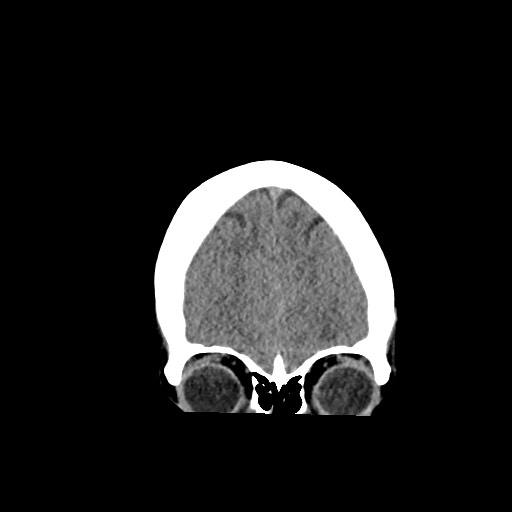Acute subarachnoid hemorrhage and accessory anterior cerebral artery (Radiopaedia 69231-79008 Coronal non-contrast 16).jpg