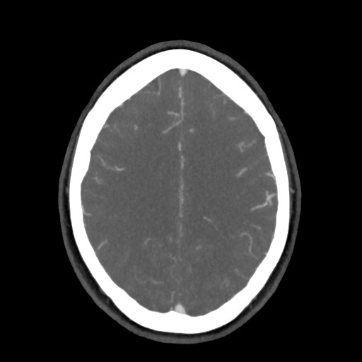 Acute subarachnoid hemorrhage and accessory anterior cerebral artery (Radiopaedia 69231-79009 D 49).jpg