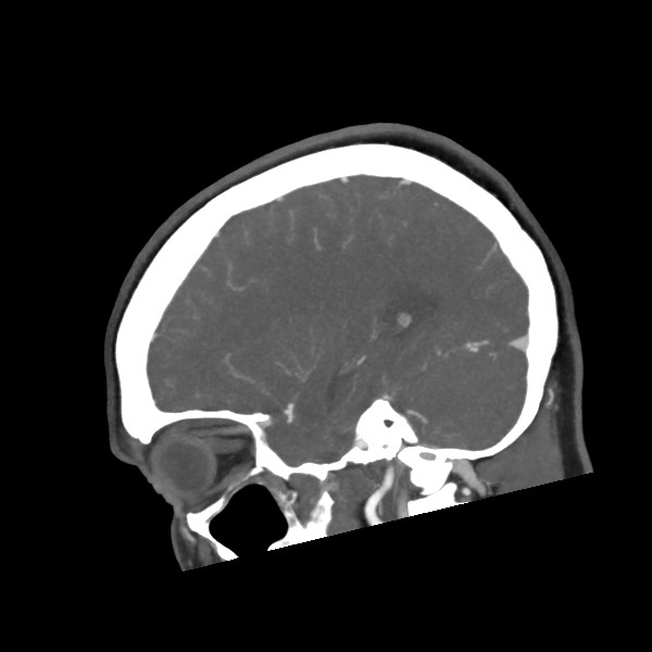 Acute subarachnoid hemorrhage and accessory anterior cerebral artery (Radiopaedia 69231-79009 Sagittal C+ arterial phase 50).jpg