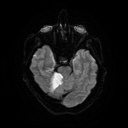 Acute superior cerebellar artery territory infarct (Radiopaedia 84104-99358 Axial DWI 22).jpg