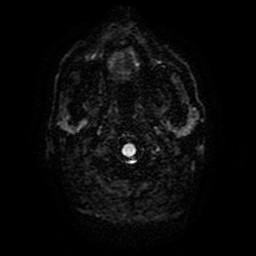 Acute superior cerebellar artery territory infarct (Radiopaedia 84104-99358 Axial DWI 31).jpg