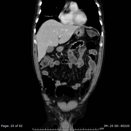 Acute superior mesenteric artery occlusion (Radiopaedia 43636-47060 Coronal C+ portal venous phase 10).jpg