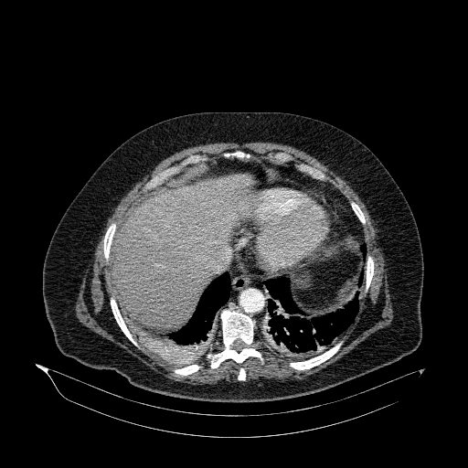 File:Acute superior mesenteric artery occlusion (Radiopaedia 51288-56960 Axial C+ arterial phase 5).jpg