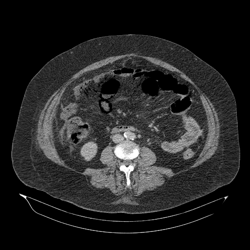 Acute superior mesenteric artery occlusion (Radiopaedia 51288-56960 Axial C+ portal venous phase 56).jpg