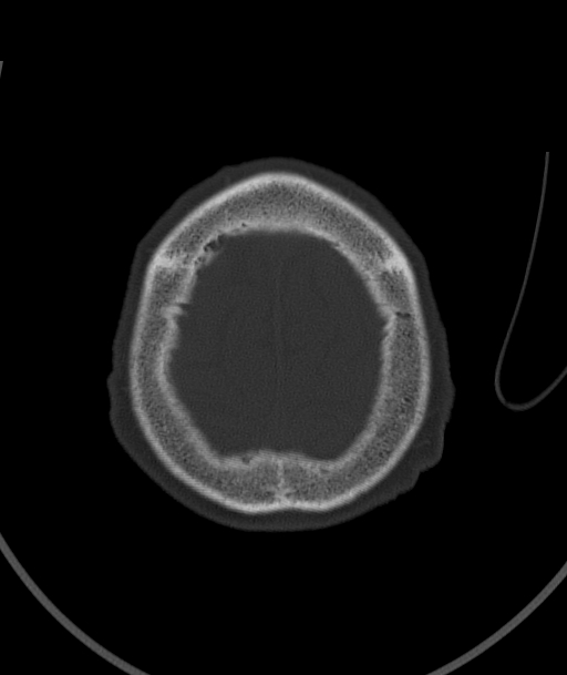 Acute traumatic subdural hematoma (Radiopaedia 82921-97257 Axial bone window 19).jpg