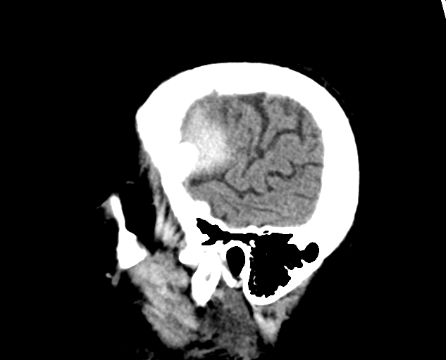 File:Acute traumatic subdural hematoma (Radiopaedia 82921-97257 Sagittal non-contrast 15).jpg