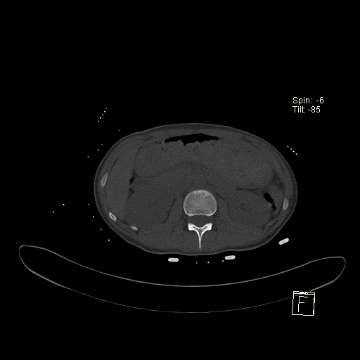 File:Acute vertebral compression fracture (Radiopaedia 63832-72559 Axial bone window 18).jpg