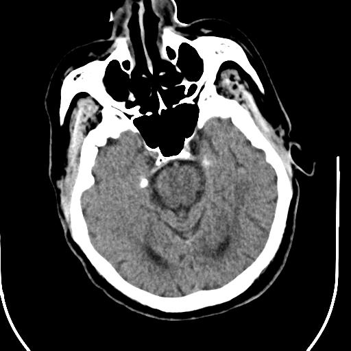 Acute vertebrobasilar ischemic infarction (Radiopaedia 25220-25473 Axial non-contrast 21).jpg