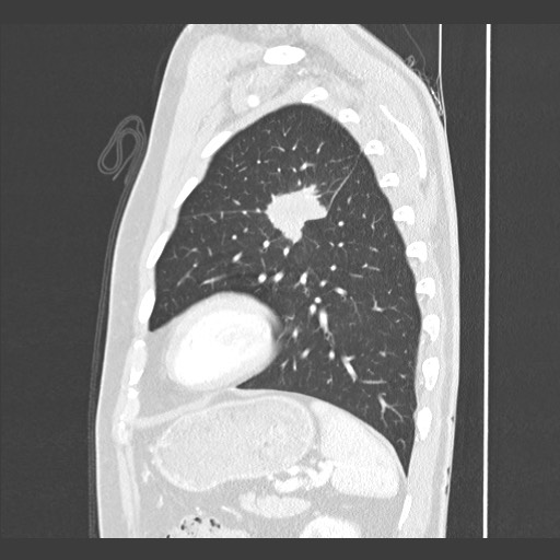 Adenocarcinoma of the lung (Radiopaedia 59871-67325 Sagittal lung window 79).jpg