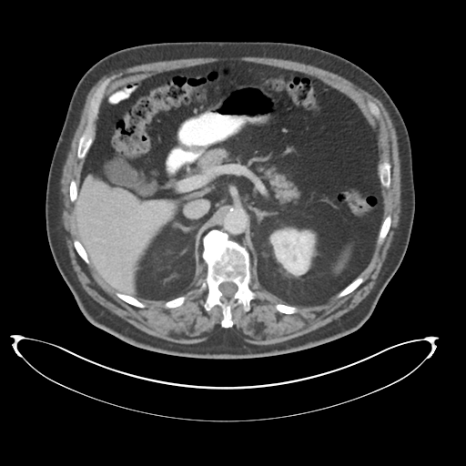 Adenocarcioma of rectum- T1 lesion (Radiopaedia 36921-38547 Axial C+ portal venous phase 28).png