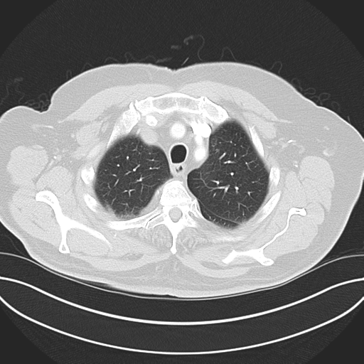 Adenocarcioma of rectum- T1 lesion (Radiopaedia 36921-38547 Axial lung window 14).png
