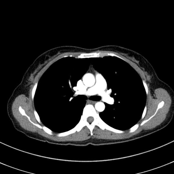 Adenocystic carcinoma of the trachea (Radiopaedia 47677-52525 Axial C+ arterial phase 48).jpg