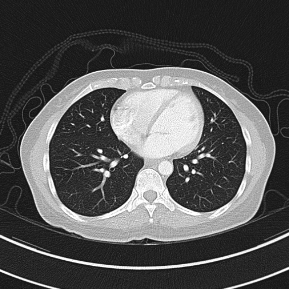 Adenocystic carcinoma of the trachea (Radiopaedia 47677-52525 Axial lung window 61).jpg