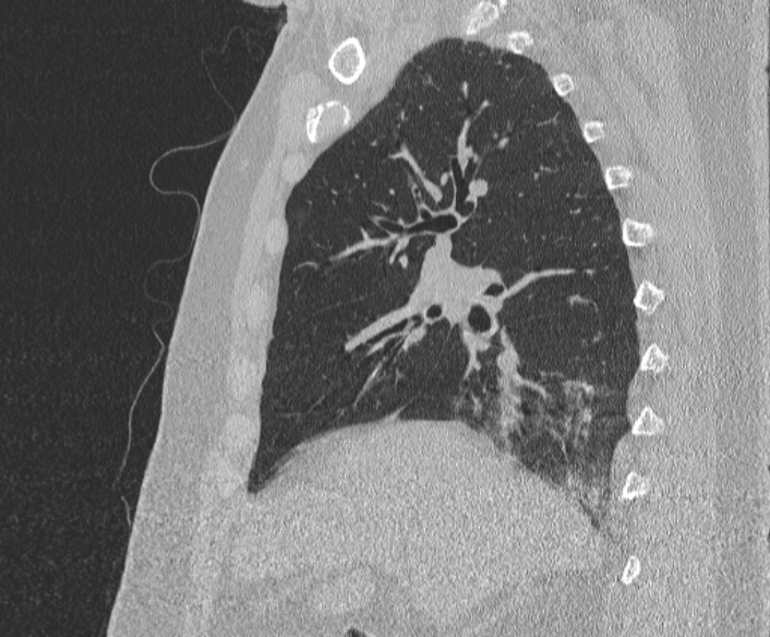 Adenoid cystic carcinoma of the trachea (Radiopaedia 49042-54137 Sagittal lung window 176).jpg