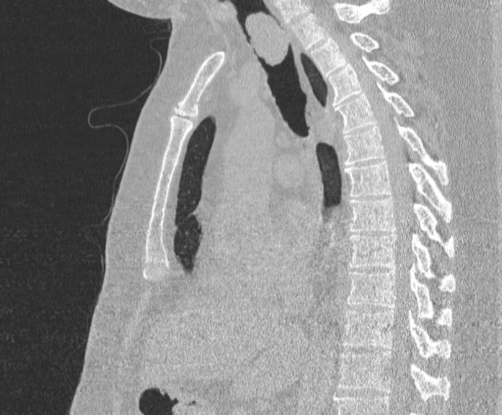Adenoid cystic carcinoma of the trachea (Radiopaedia 49042-54137 Sagittal lung window 233).jpg