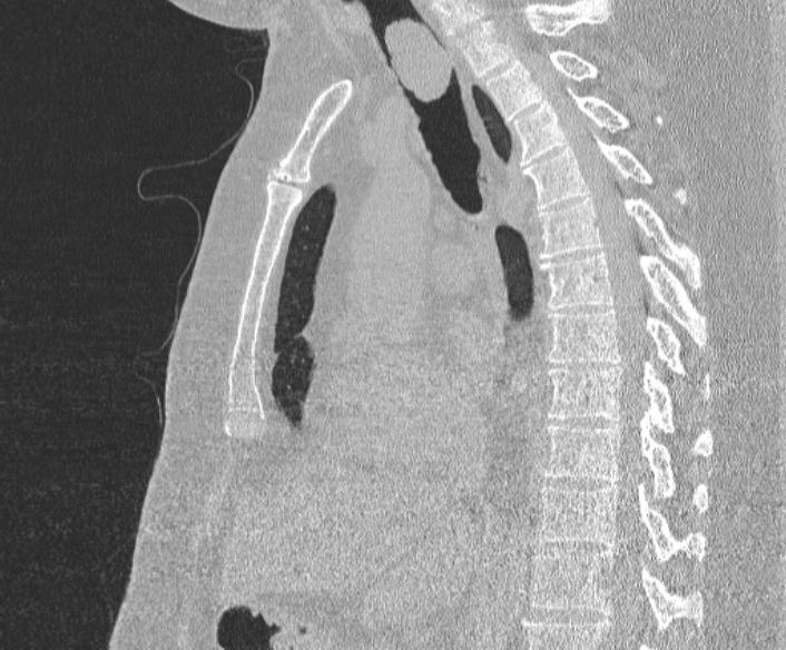 Adenoid cystic carcinoma of the trachea (Radiopaedia 49042-54137 Sagittal lung window 234).jpg