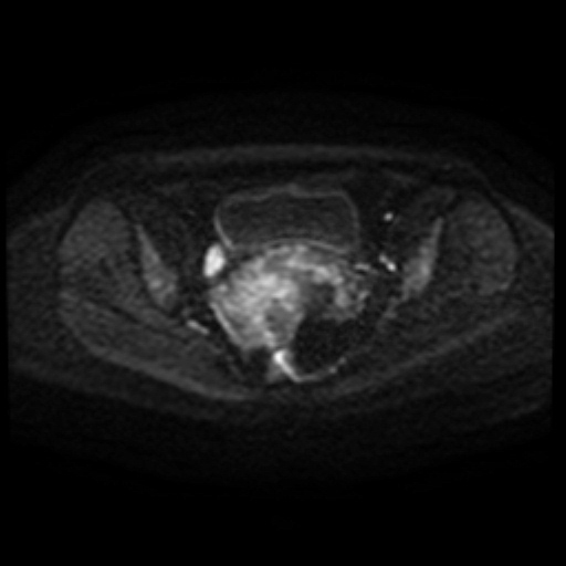 Adenoma malignum of cervix (Radiopaedia 66441-75705 Axial DWI 87).jpg
