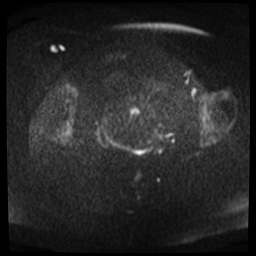 File:Adenomyosis-scar endometriosis (Radiopaedia 65863-75022 Axial DWI 11).jpg