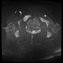 File:Adenomyosis-scar endometriosis (Radiopaedia 65863-75022 Axial DWI 16).jpg