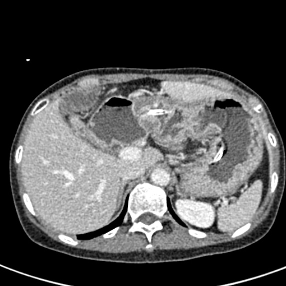 Adhesional small bowel obstruction (Radiopaedia 48397-53305 Axial C+ portal venous phase 14).jpg