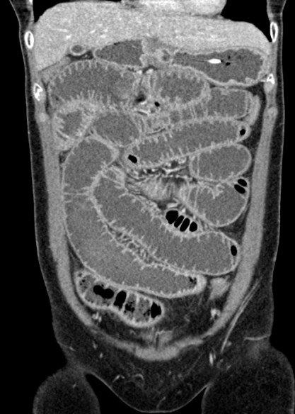Adhesional small bowel obstruction (Radiopaedia 48397-53305 Coronal C+ portal venous phase 99).jpg