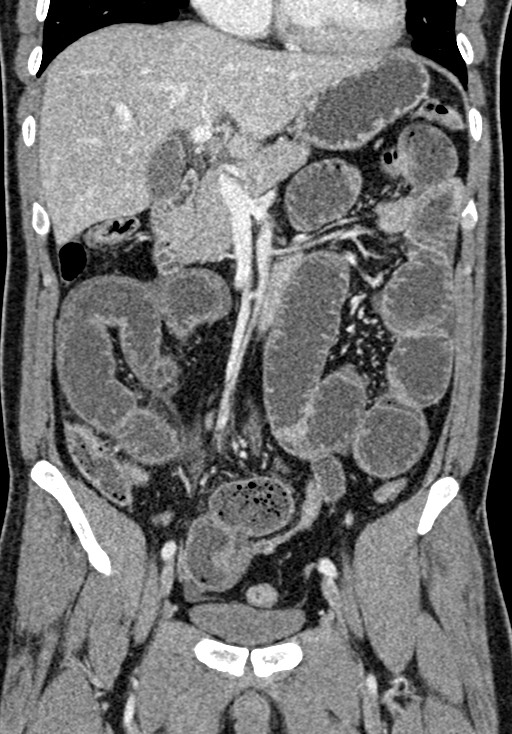Adhesional small bowel obstruction (Radiopaedia 58900-66131 Coronal C+ portal venous phase 124).jpg