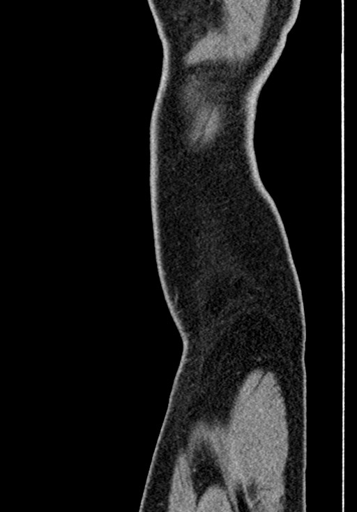 Adhesional small bowel obstruction (Radiopaedia 58900-66131 Sagittal C+ portal venous phase 248).jpg