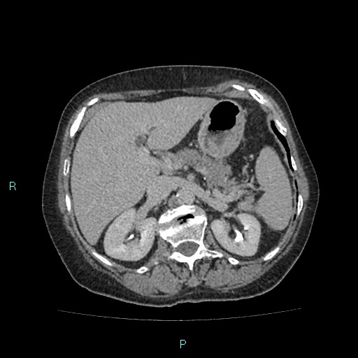 File:Adrenal collision tumor (ACT) (Radiopaedia 48462-53379 Axial C+ delayed 19).jpg