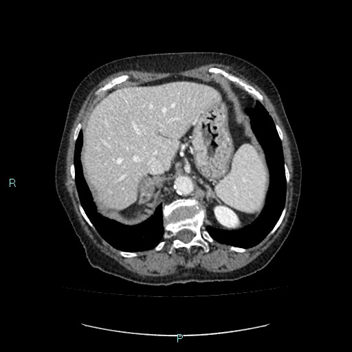 File:Adrenal collision tumor (ACT) (Radiopaedia 48462-53379 Axial C+ portal venous phase 10).jpg