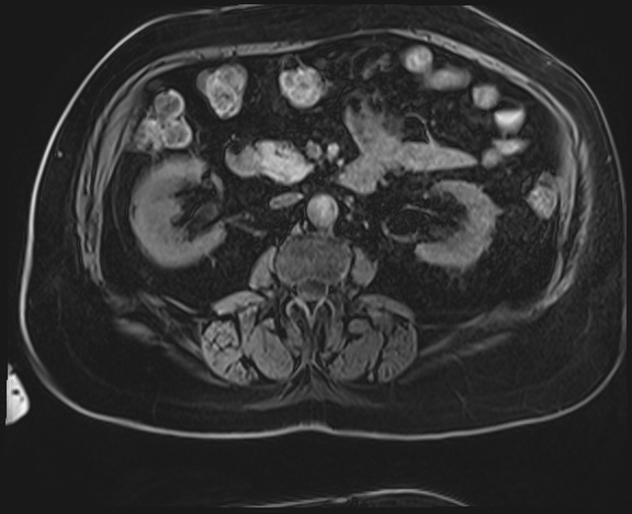 Adrenal cortical carcinoma (Radiopaedia 64017-72770 Axial T1 C+ fat sat 27).jpg