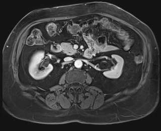 Adrenal cortical carcinoma (Radiopaedia 64017-72770 J 45).jpg