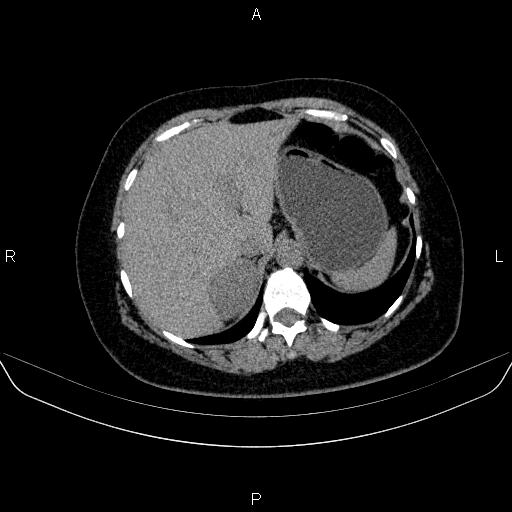File:Adrenal cortical carcinoma (Radiopaedia 84882-100379 Axial non-contrast 18).jpg