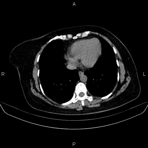File:Adrenal cortical carcinoma (Radiopaedia 84882-100379 Axial non-contrast 5).jpg
